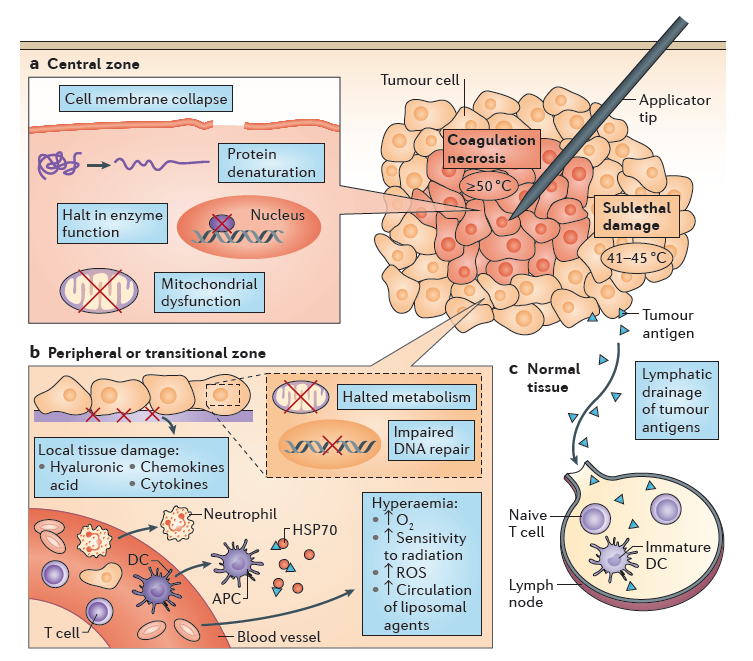熱消融原理運用,刊載於今年Nature Reviews Cancer的opinion article,右上方即為探針刺入腫瘤內圖示。 取自Nature Reviews Cancer-opinion article