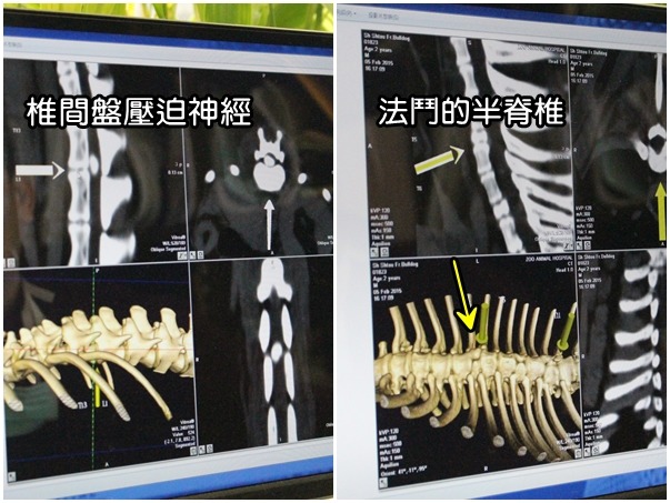 電腦斷層下的情形，右圖為法鬥先天的半脊椎、左圖為椎間盤壓迫神經造成癱瘓。　何宜/翻攝