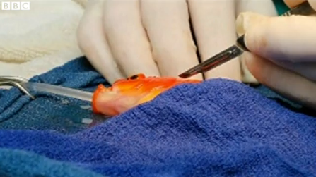 喬治接受手術取出腦瘤。 取自BBC News