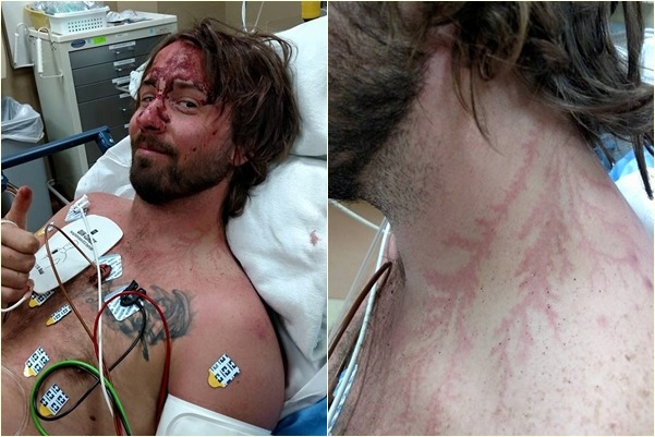 醫生從哈德曼的傷勢研判，他應是直接遭受雷擊。　取自Jonathan Tyler Hardman