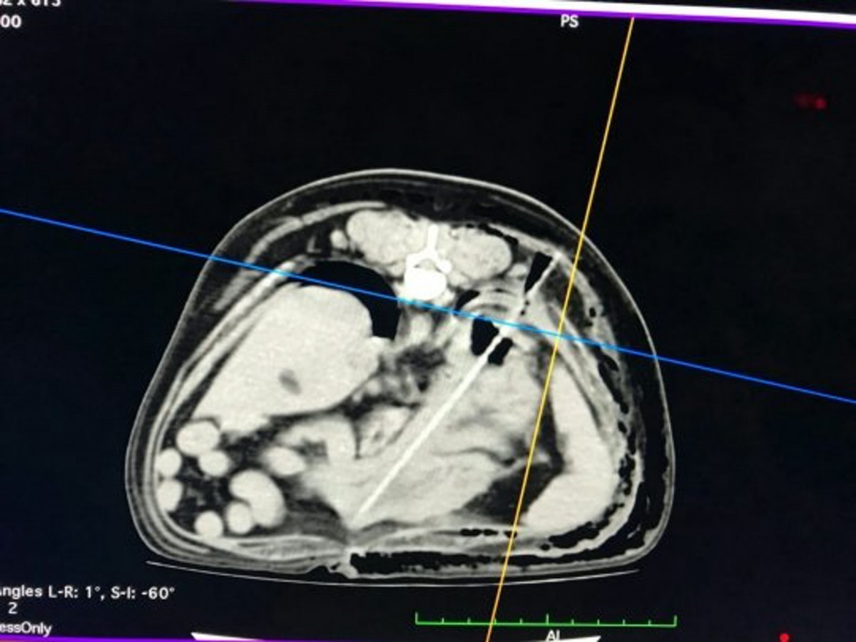 從TC中明顯看到長長的異物,在狗狗的身體內。(SWNS)