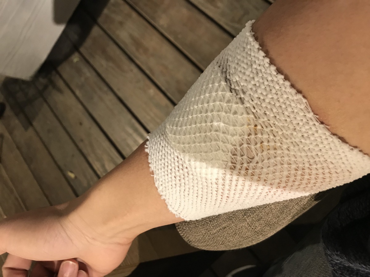 員警李昌哲欲將「胖胖」帶回警局時，不慎遭咬傷右手臂。雨林/翻攝