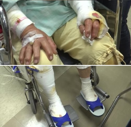 阿嬤全身上下有超過百道浪犬的抓痕和咬痕，縫了30多針。擷取新聞畫面