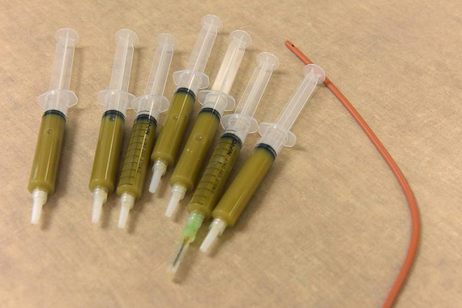 餵食管和糞水注射器。康拉德表示，1次糞便移植療程的成功率為87%；那些需要2次療程的狗兒，其成功率則為93%，且自此不再腹瀉。 取自《雷登頓先驅報》