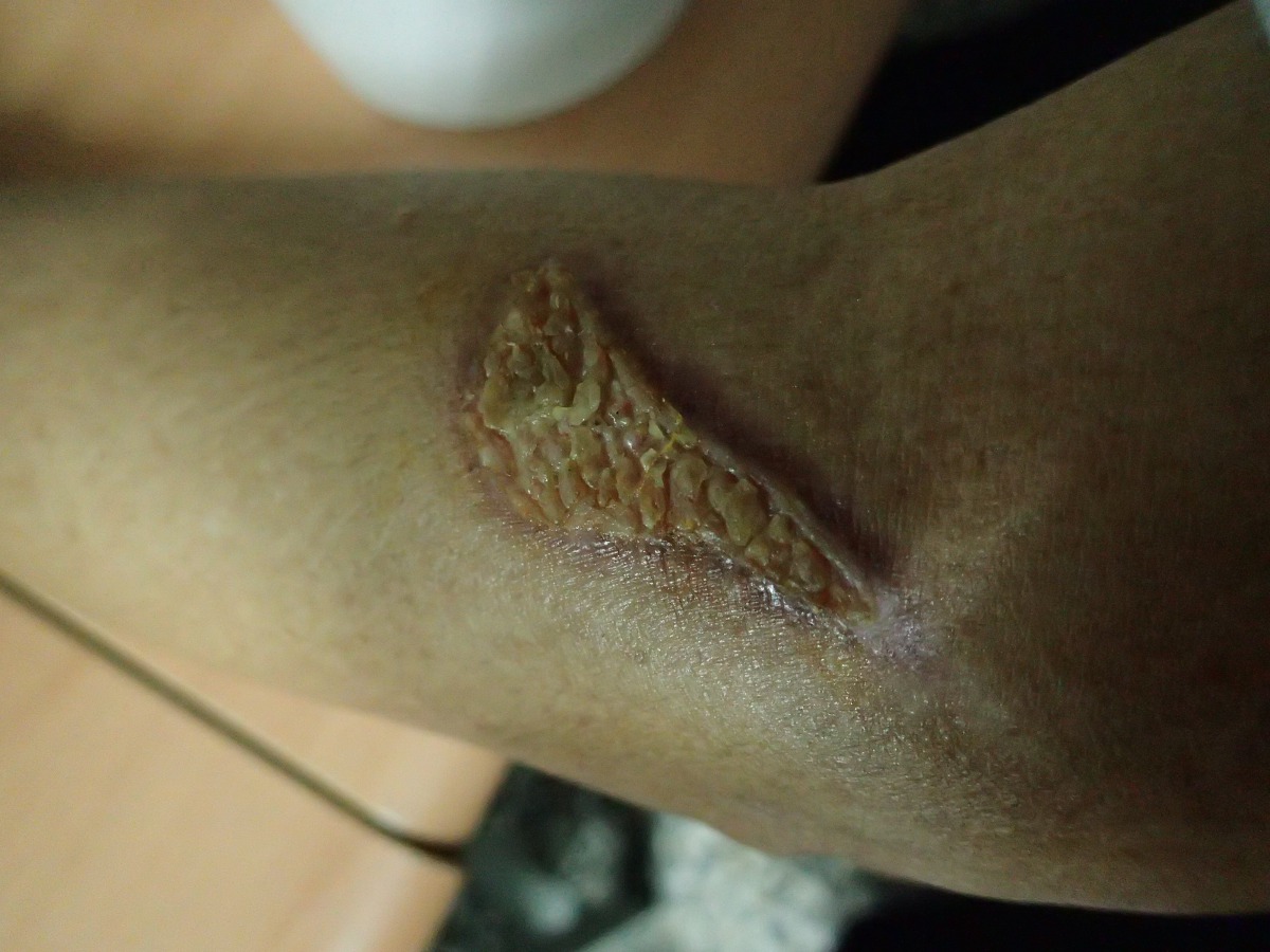 基隆鳥會高旗常務監事被荔枝椿象臭液腐蝕的傷口。基隆鳥會/提供