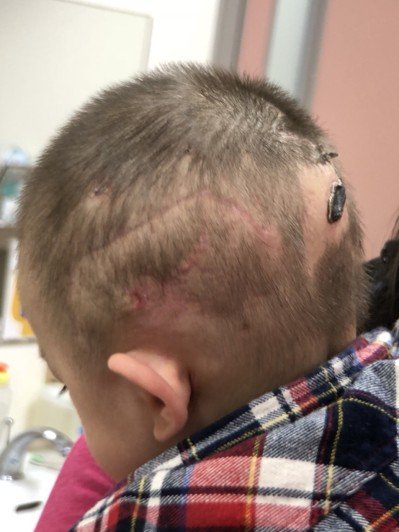 遭比特犬攻擊頭部的男童已順利康復出院。 台東馬偕醫院/提供